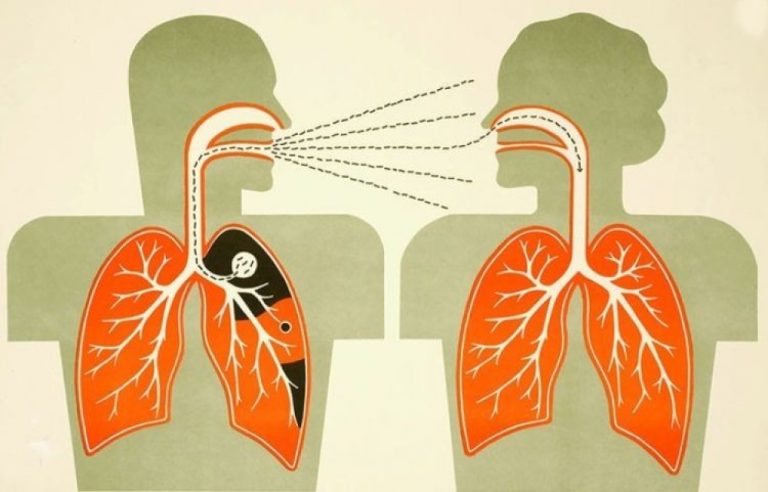 Өнөөдөр дэлхий нийтээр сүрьеэтэй тэмцэх өдөр тохиож байна